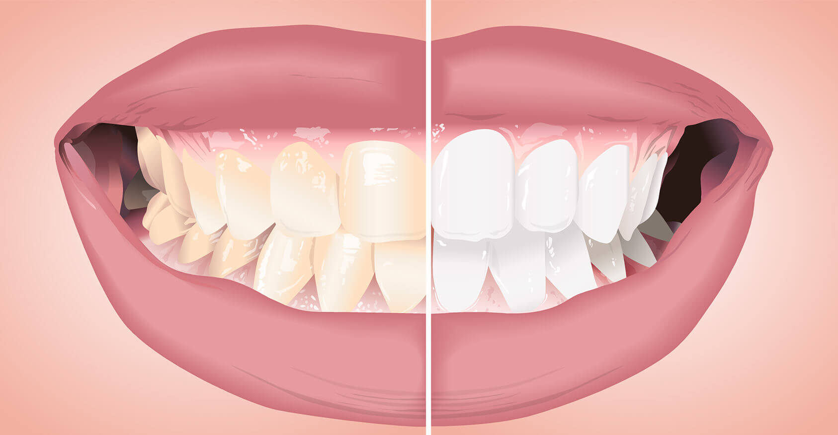 sbiancamento dentale (2)